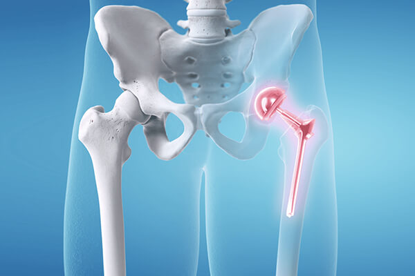 Hip replacement surgeon in vasai